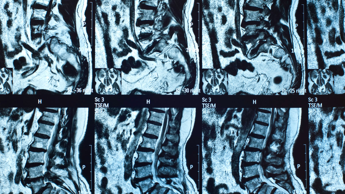 Should You Get an MRI Scan for a Low Back Injury?